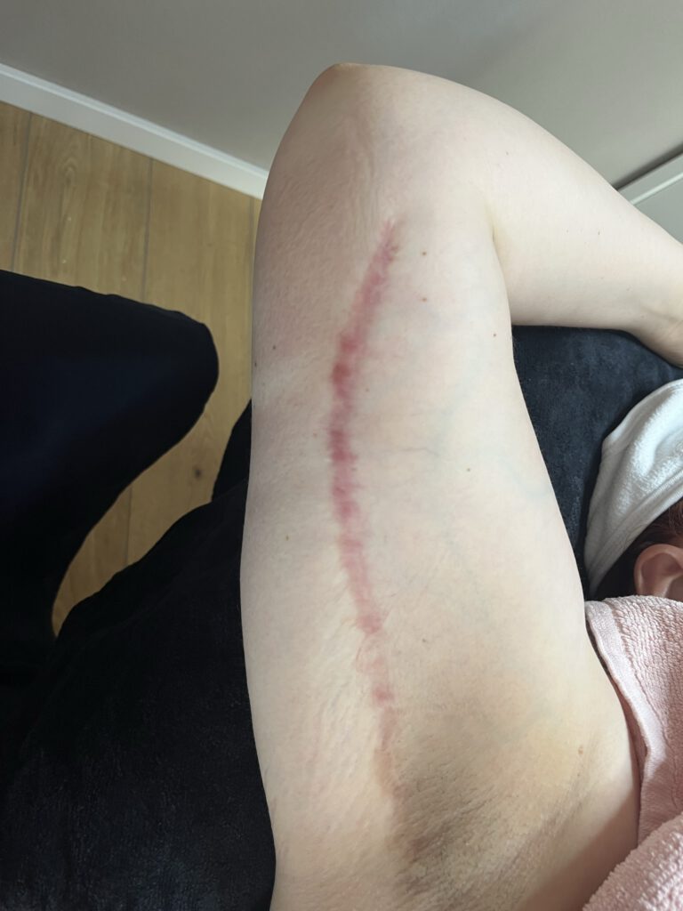 Narbe nach einer Armstraffung, welche mit einer Inkless Behandlung behandelt wurde um die Narbe weicher und geschmeidiger zu bekommen.